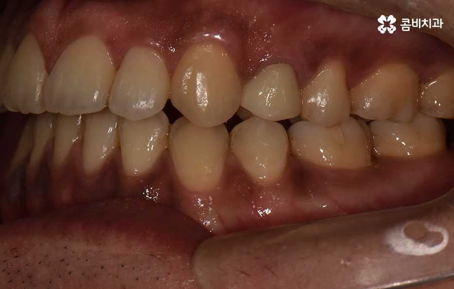 성인 부정교합 교정 더는 미루고 싶지 않다면 관련 이미지 8