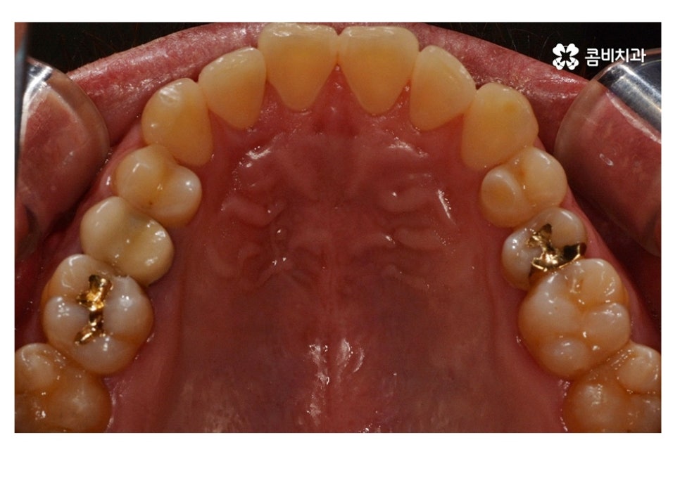 20대임플란트 잦아지는 이유를 알아본다면 관련 이미지 7