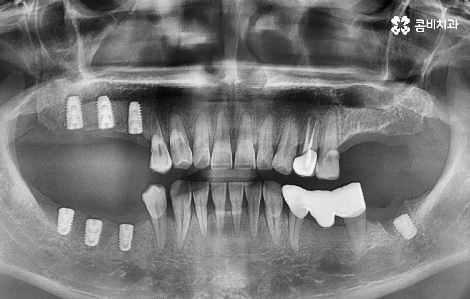 40대임플란트 치과에 이건 알고 가세요 관련 이미지 8