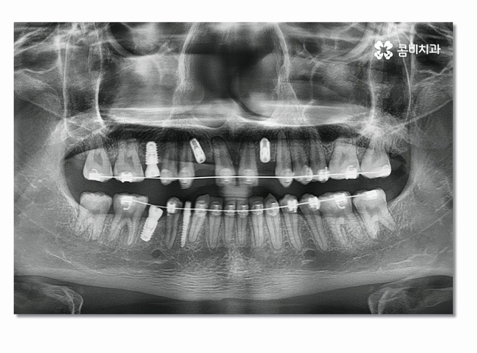 앞니임플란트 합리적으로 접근하려면 관련 이미지 3