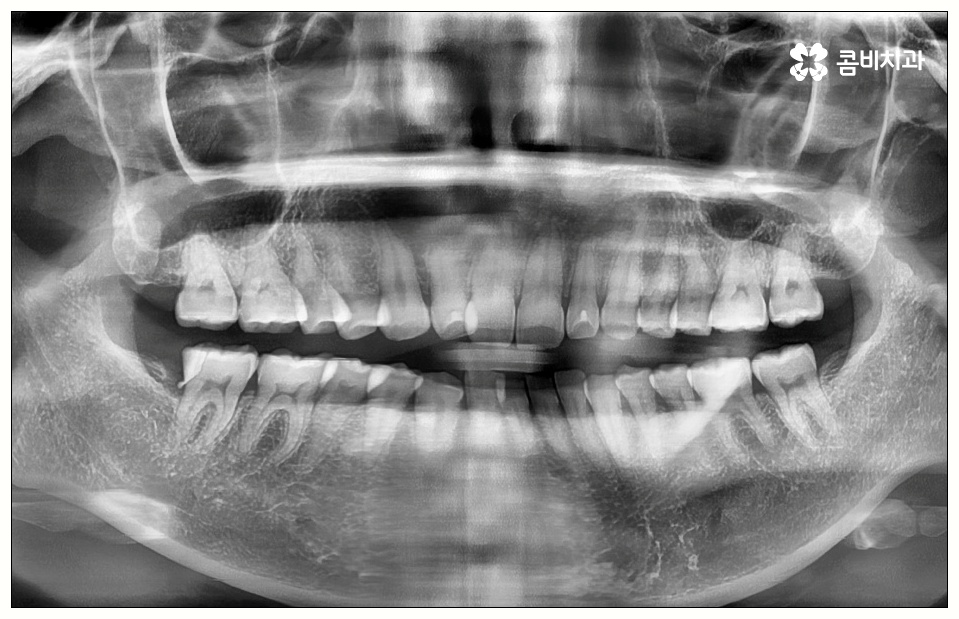 어금니 사이 충치 빠르게 대응해야 관련 이미지 1