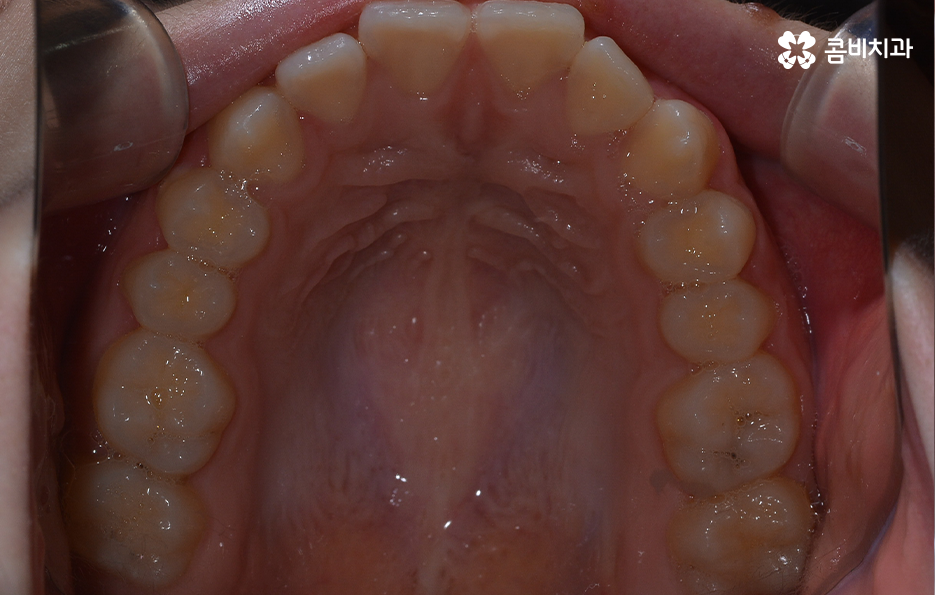 치아 벌어짐 교정으로 앞니 돌출까지 해결하기 관련 이미지 4