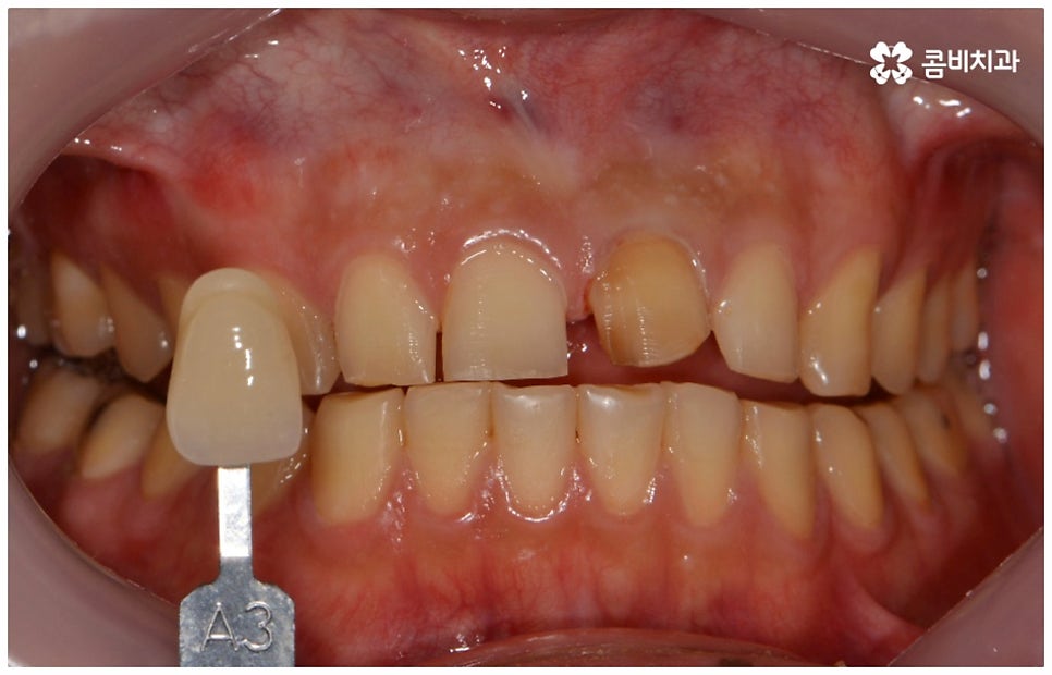 앞니충치치료 어떻게 이뤄지나요 관련 이미지 9