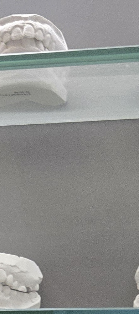 앞이빨 임플란트 과정 주의해야할 포인트는 관련 이미지 14