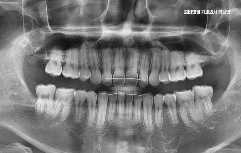 완전매복사랑니 발치 대학병원 꼭 가야하나요 관련 이미지 5
