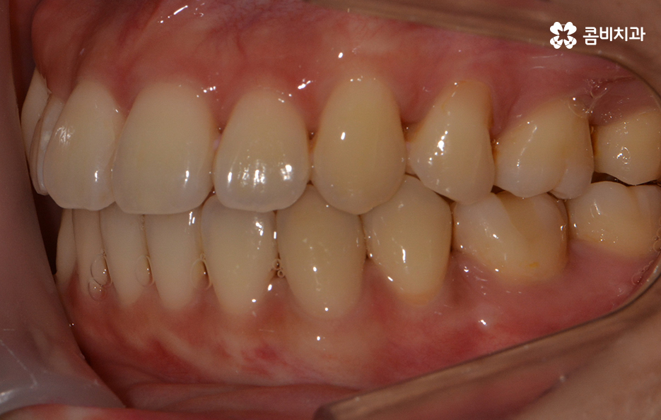 앞니치아교정 자연스러운 결과를 위해 알아둬야 할 점 관련 이미지 12