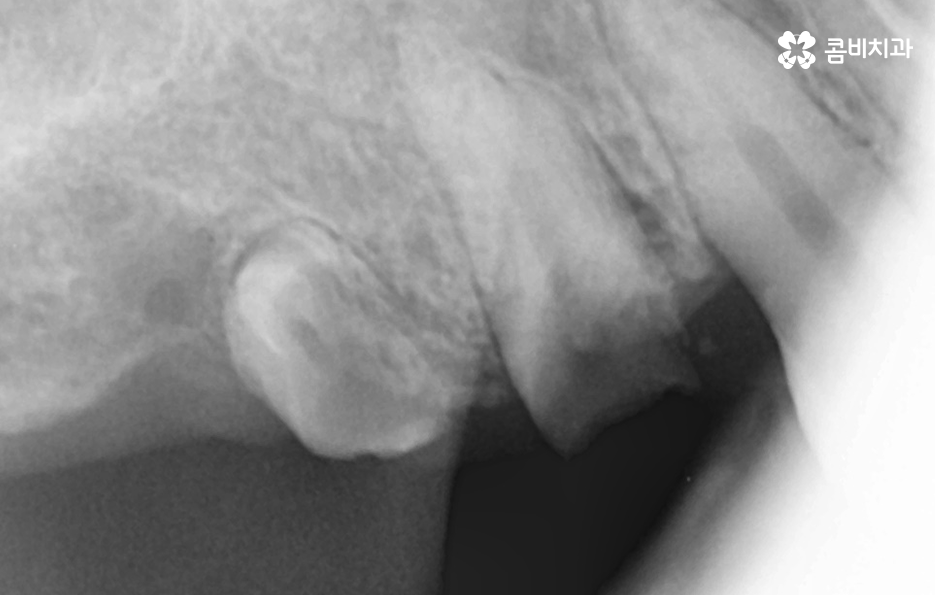 임플란트 치료기간 어느정도 걸리고 치과에는 몇번 가나요 관련 이미지 2