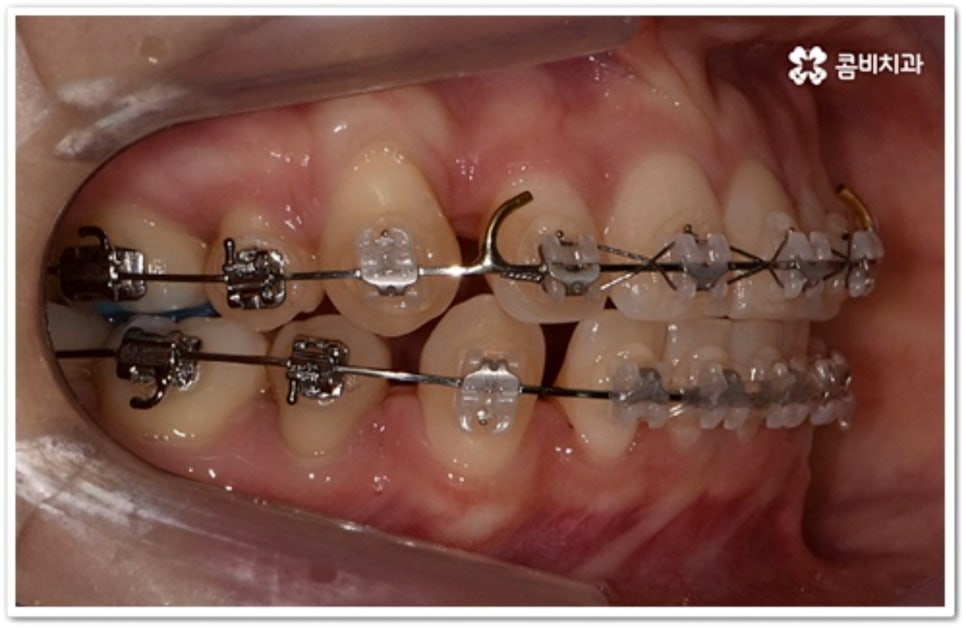 덧니 발치 언제 하나요? 관련 이미지 9