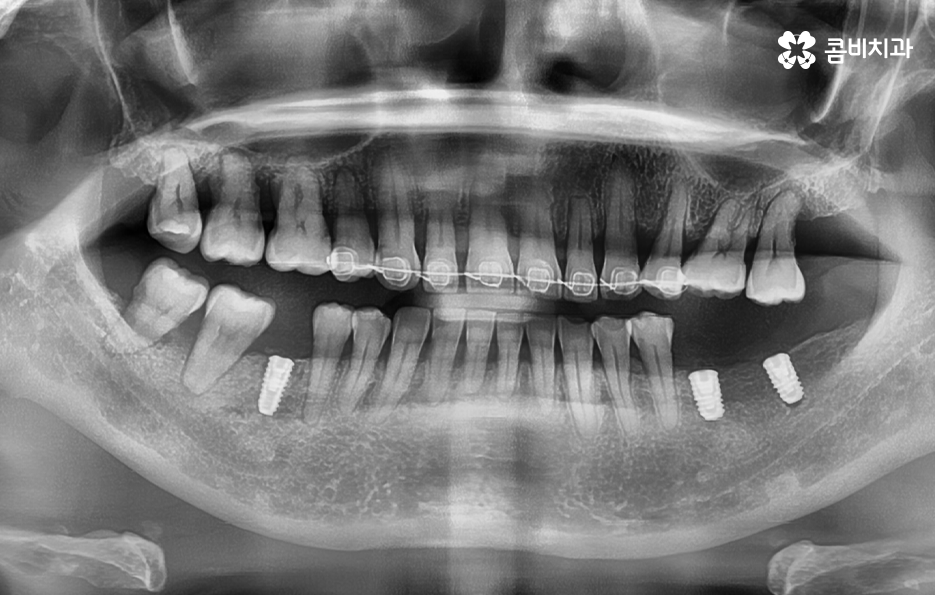 임플란트 해야 하는데 치아교정이 하고 싶다면 관련 이미지 7