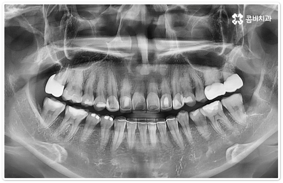 누운사랑니발치 이모저모 알아봐요 관련 이미지 4