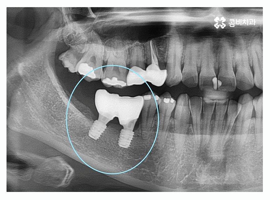 임플란트종류 잘알아보고 적용하려면 관련 이미지 9