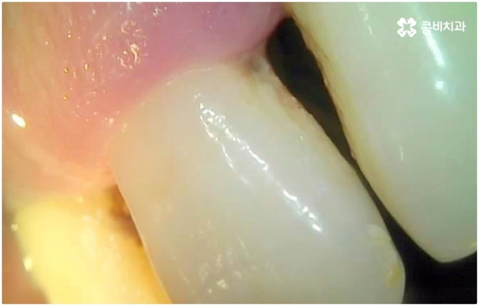 발치후 임플란트 바로 되나요? 관련 이미지 6