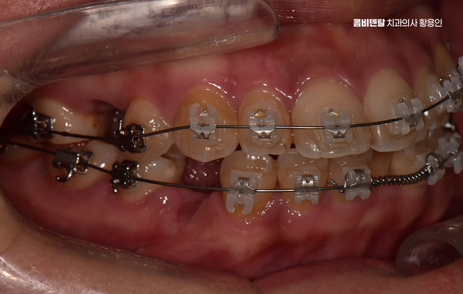 Could the Cause of Protruding Front Teeth Make a Difference? image 8