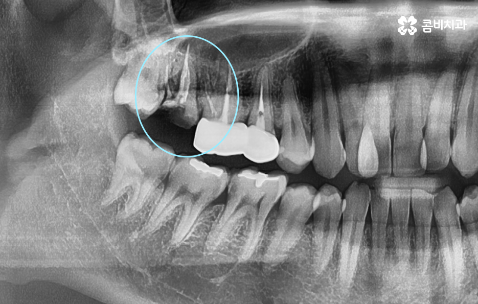 어금니 충치 발치 결국 뽑아야 할때와 살릴 수 있는 케이스 관련 이미지 1