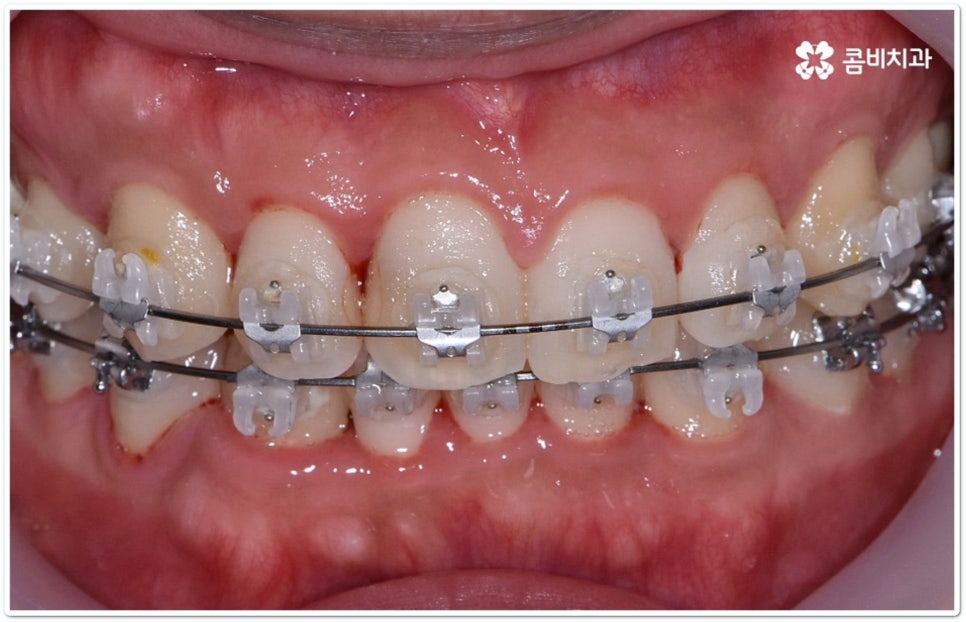클리피씨교정 합리적인 초이스! 관련 이미지 9