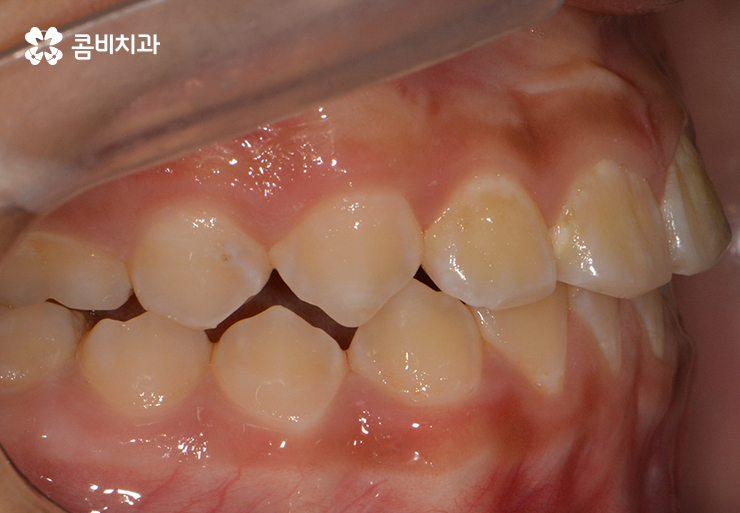 성장기치아교정 어떻게 접근하는 것이 좋을까 관련 이미지 7