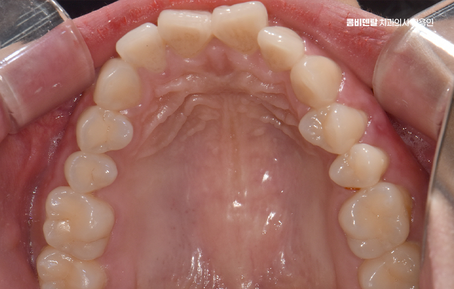 돌출입 팔자주름 교정 얼마나 바뀔까요 관련 이미지 4