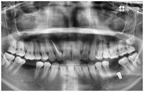 임플란트 종류 어떤게 맞을까요? 관련 이미지 2