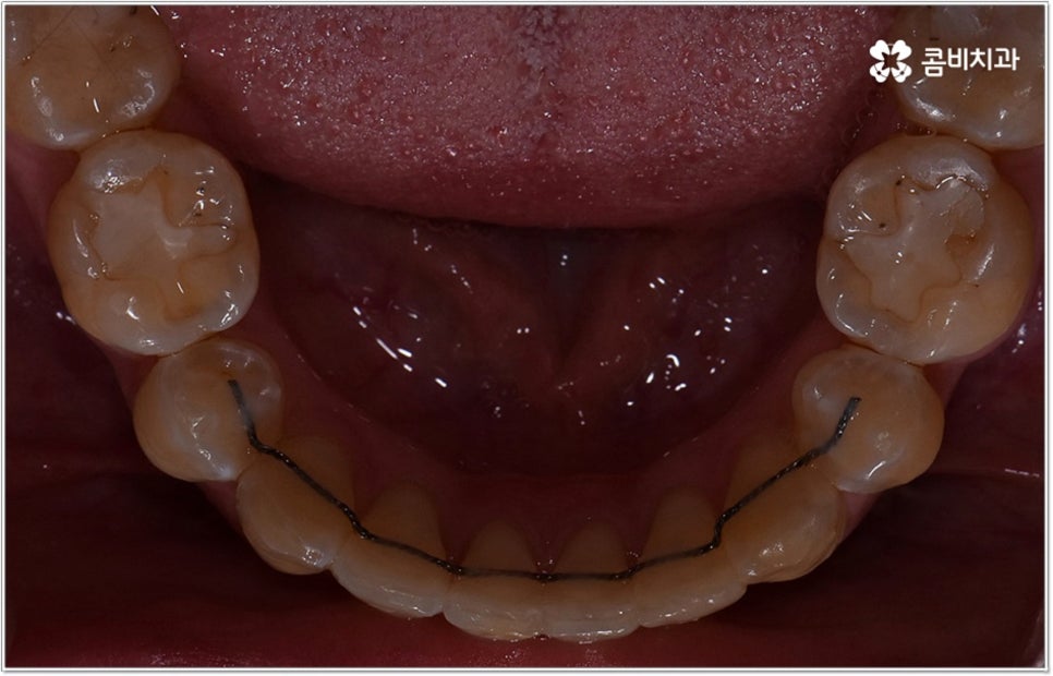 비발치치아교정 언제 할수있나요 관련 이미지 12