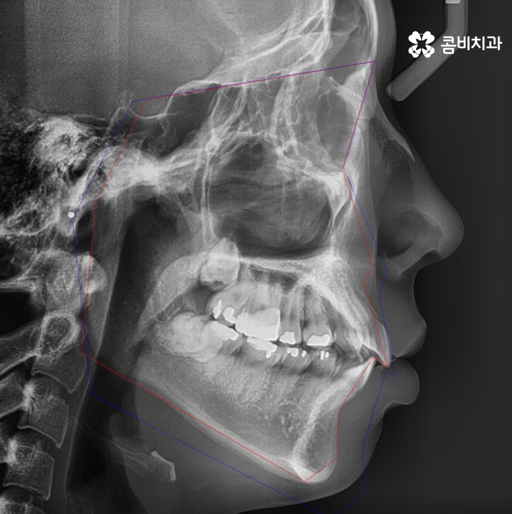 콤비교정 나에게 적합한지 판단하려면 관련 이미지 5