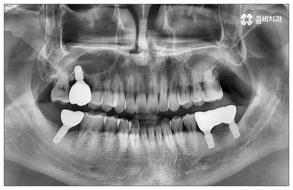 건강보험임플란트 혜택받아 보세요 관련 이미지 14