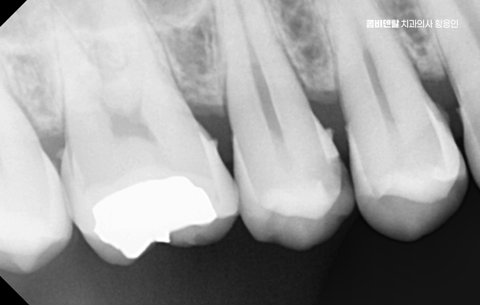 충치 치아 깨짐 시점이 관건이라면 관련 이미지 6