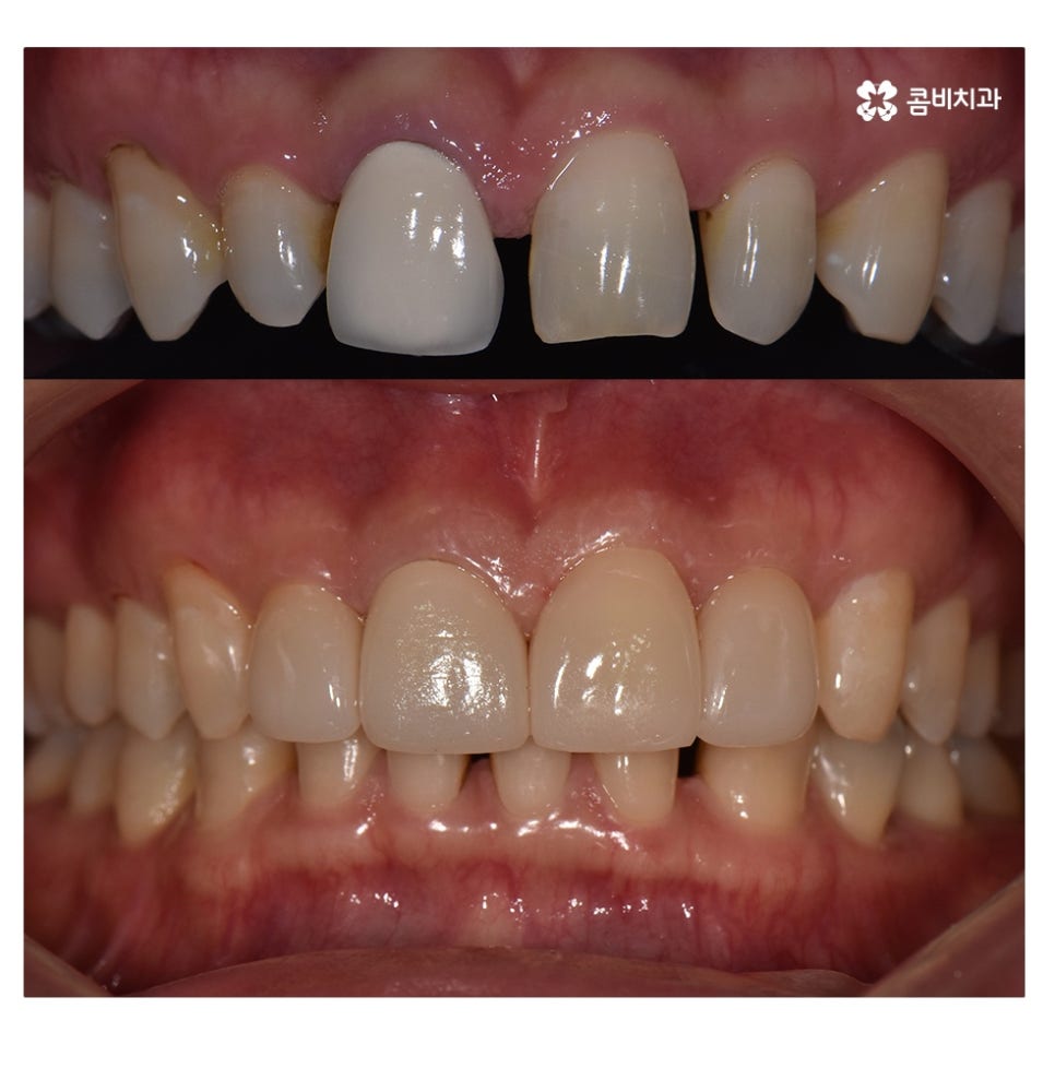 무삭제라미네이트 포인트부터 잘 알고 시작하려면 관련 이미지 7