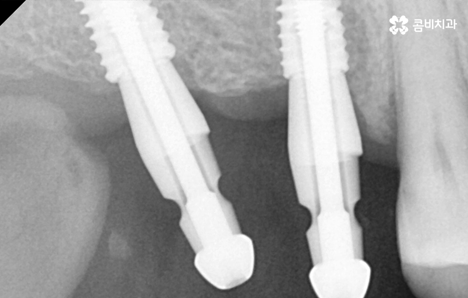 어금니 임플란트 기간 얼마나 예상해야 하나요 관련 이미지 5