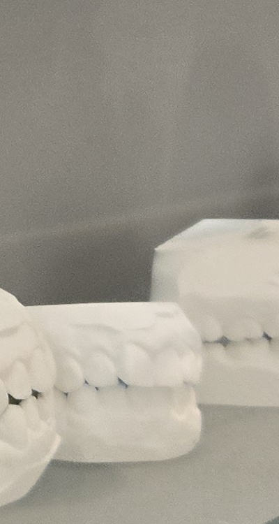 앞니 틀어짐 부분교정 얼마나 걸릴까 관련 이미지 37