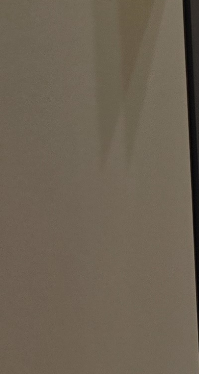 아말감 교체 레진 인레이 어떻게 대처하면 될까 관련 이미지 24