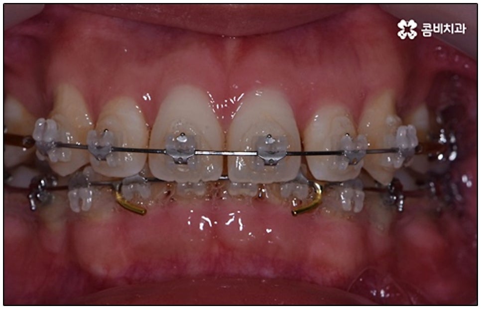 클리피씨교정 알아봐야 할것들 관련 이미지 6