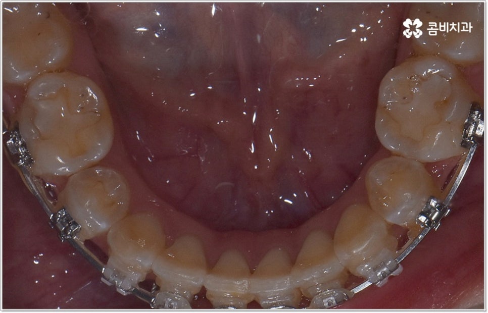 비발치치아교정 언제 할수있나요 관련 이미지 9