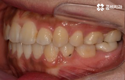 클리피씨교정 알아볼 때 꼭 신경 써야 하는 점은! 관련 이미지 12