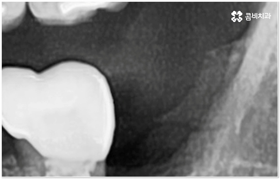 치아 사이 충치 어떻게 하나요 관련 이미지 8