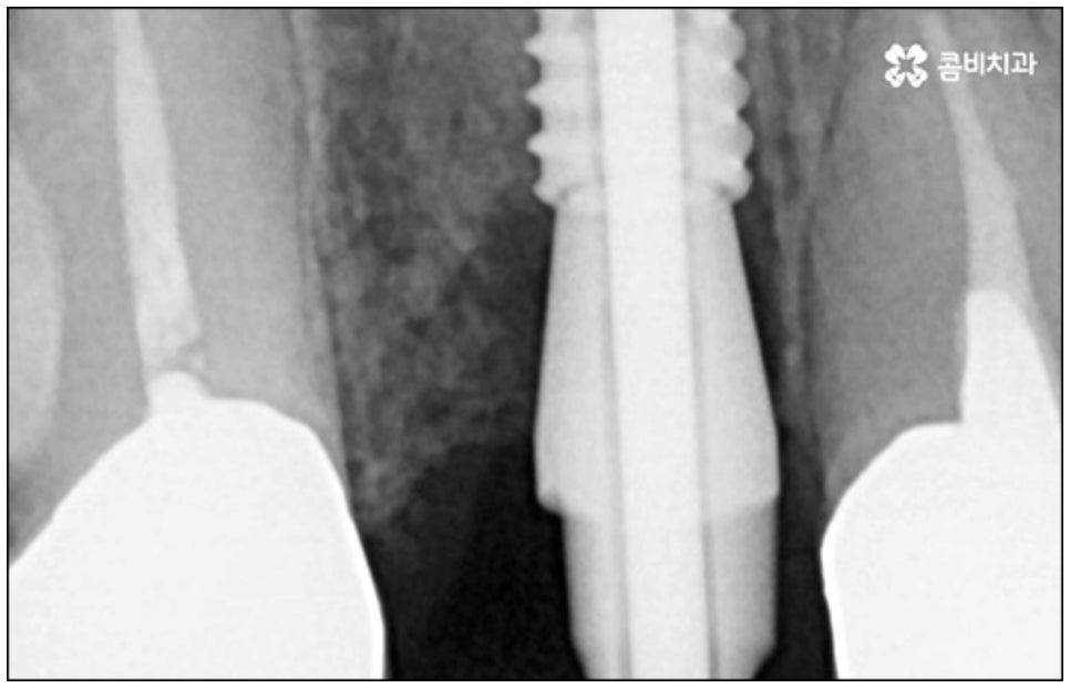 당일임플란트 나도 할수있나요 관련 이미지 9