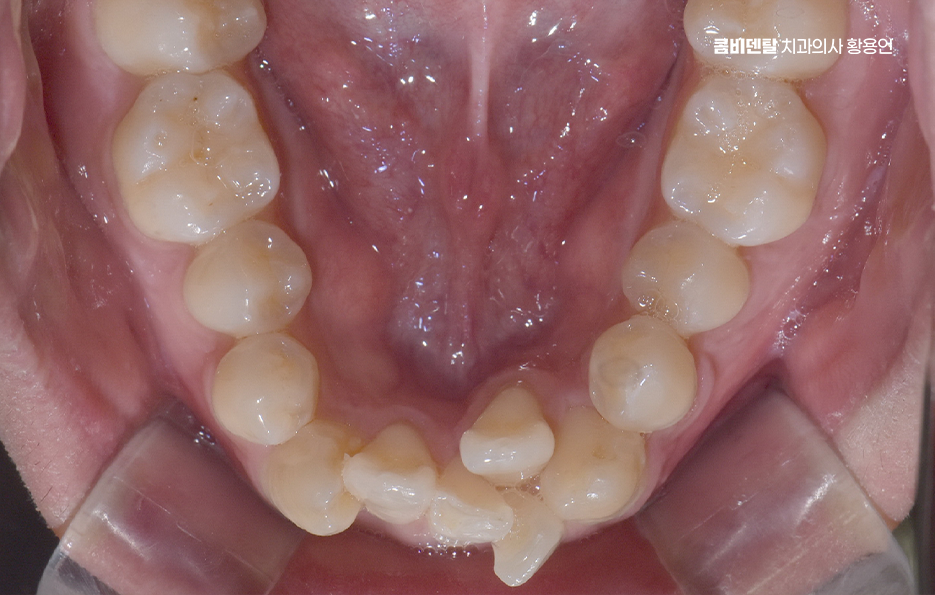 Can Crooked Lower Teeth Be Improved Without Extraction? image 6