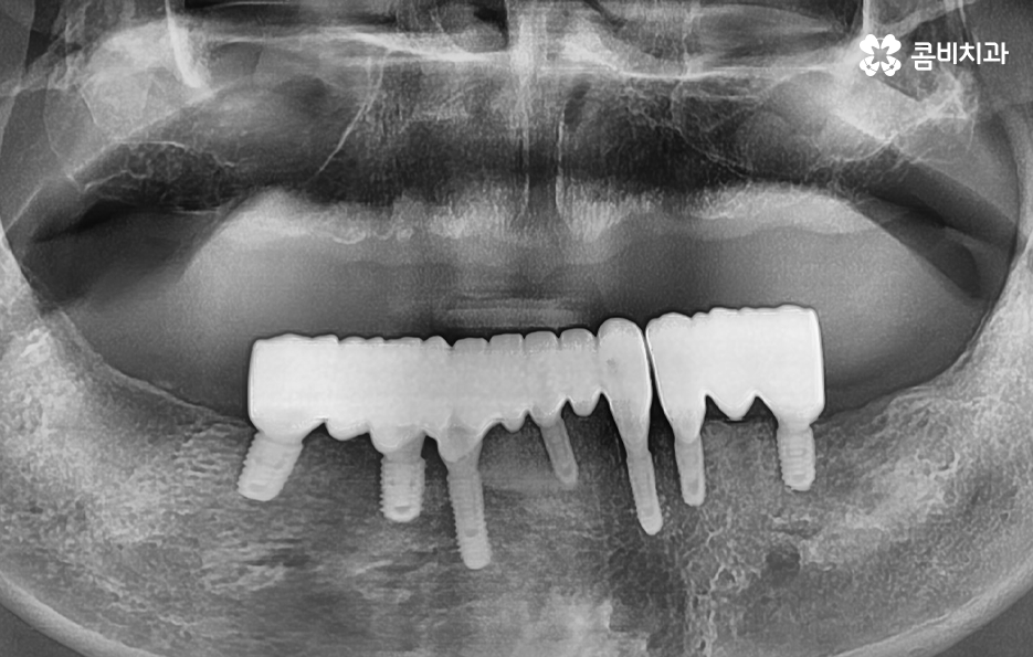전체임플란트 어떤 방식으로 해야하나요 관련 이미지 7