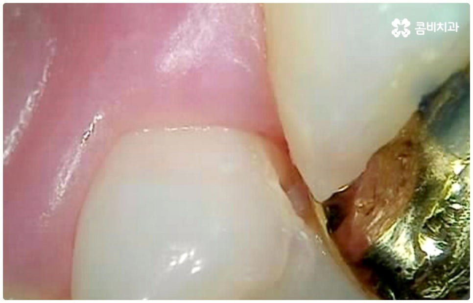 충치치료종류 알아볼까요? 관련 이미지 7