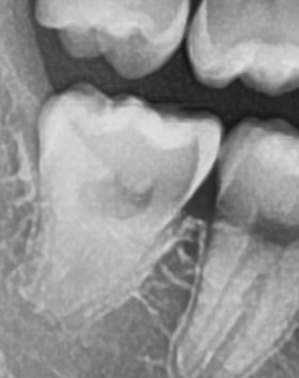어금니 뒤 잇몸 부음 어떤 문제길래 이런거죠 관련 이미지 30