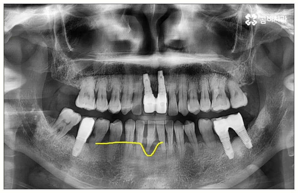 원데이임플란트 어떤가요? 관련 이미지 1