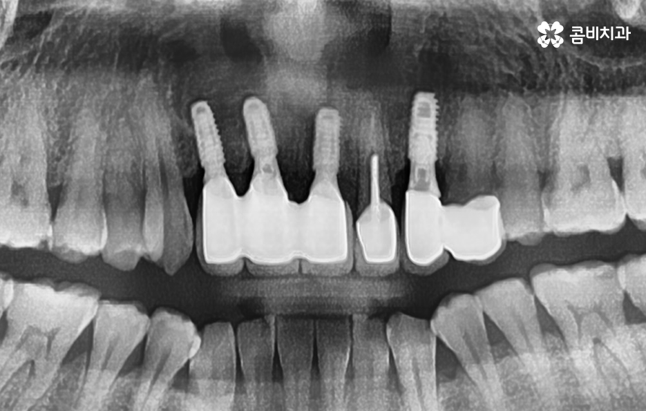 앞이빨 임플란트 과정 주의해야할 포인트는 관련 이미지 8