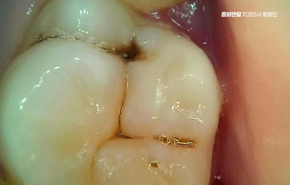 충치치료 아픈가요 미리 알고 예상하려면 관련 이미지 8