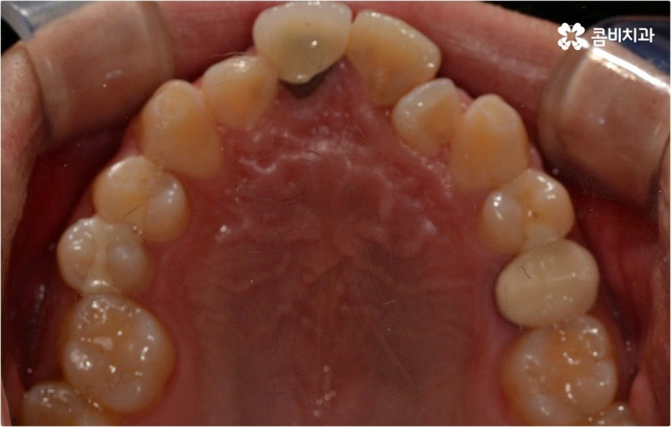 덧니교정 하고싶다면 관련 이미지 4
