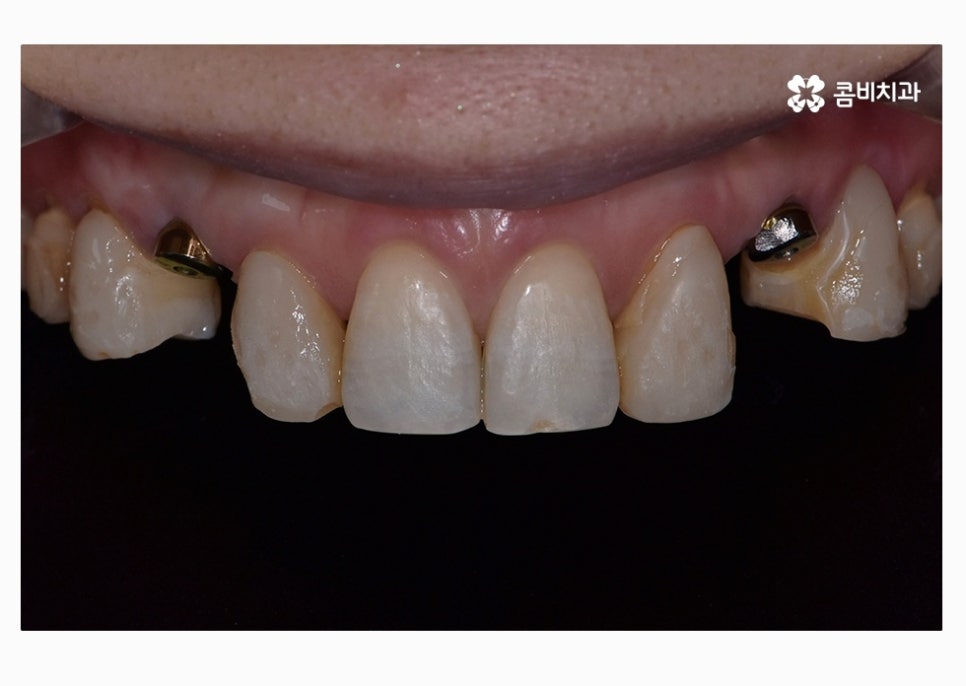 30대임플란트 향후 미래를 바라본다면 관련 이미지 10