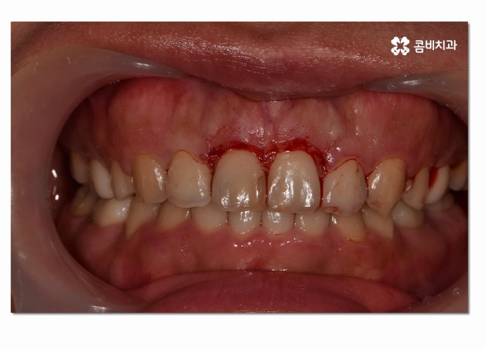 치주질환 치료의 중요성과 치은절제술이 활용된 사례 관련 이미지 3