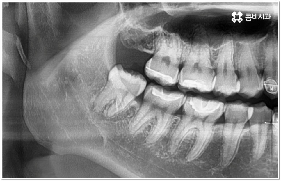아래사랑니발치 망설이고 있다면 관련 이미지 3