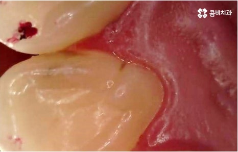 명동치과 타고난 이의 수명은 관련 이미지 7