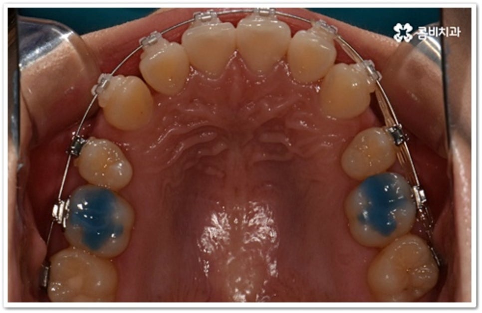덧니 발치 언제 하나요? 관련 이미지 5