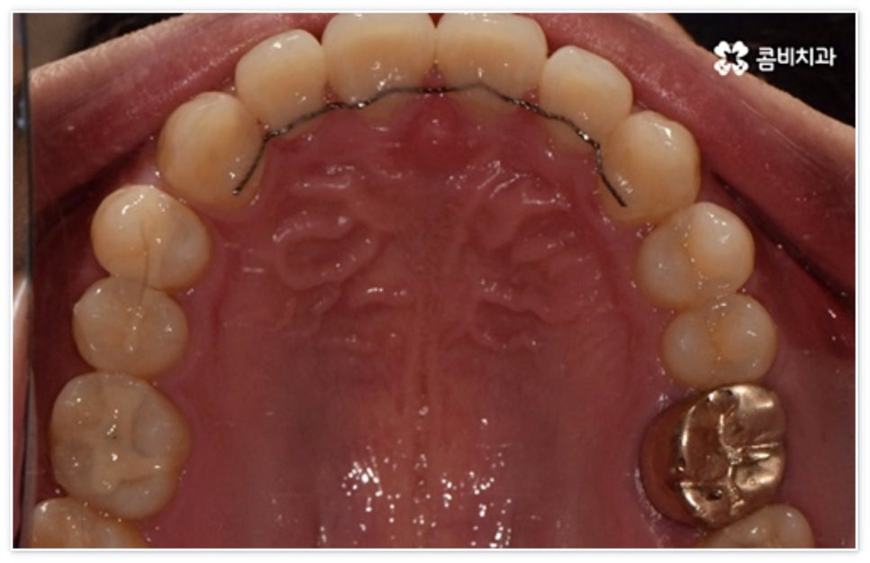 앞니 벌어짐 고치고 싶어요 관련 이미지 12