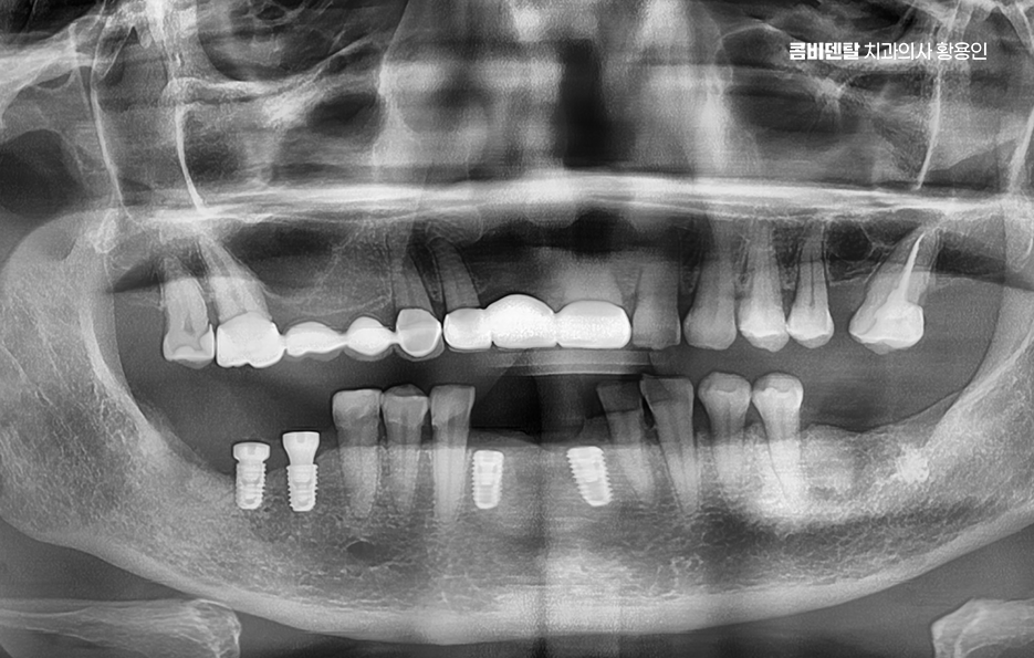임플란트의 장점 할까 말까 고민이신 분들을 위한 정리 관련 이미지 5
